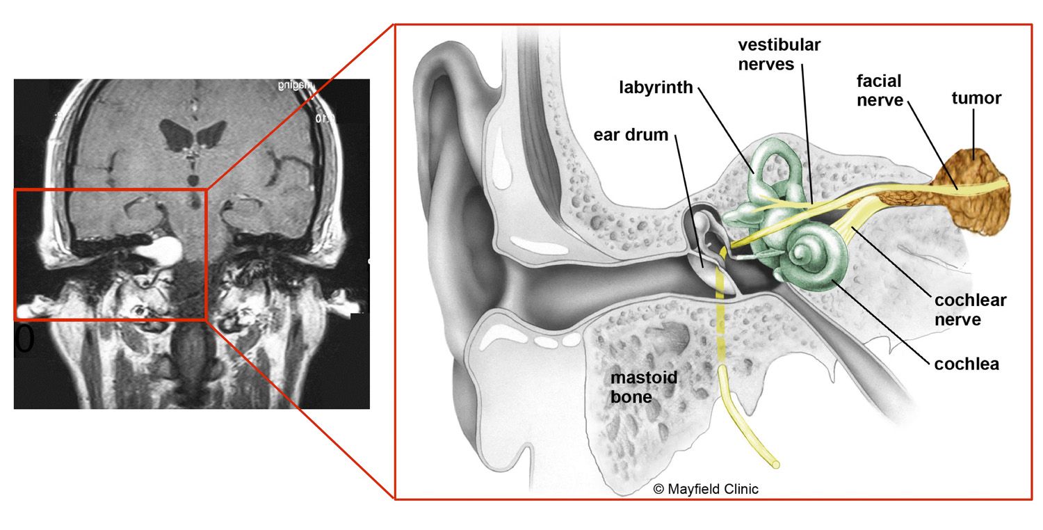 Acoustic Neuroma An MRI and diagram of the inner ear.