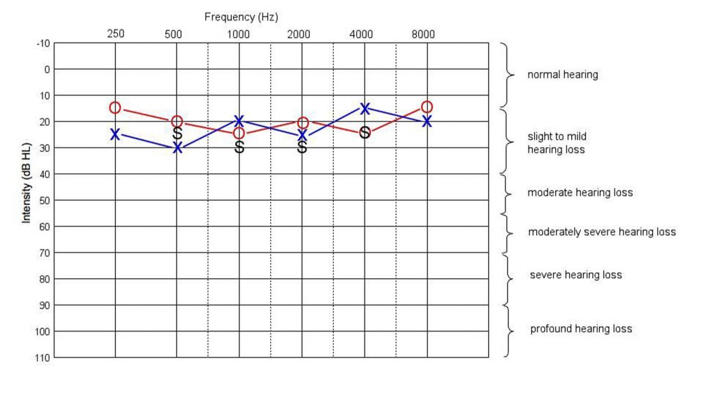 A sample audiogram depicts the left and right ear results of a hearing test.
